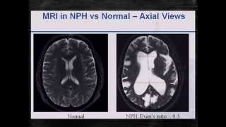 Normal Pressure Hydrocephalus Explained [upl. by Ofloda606]