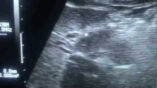 study of LIGAMENTUM TERES on ultrasound [upl. by Byron]