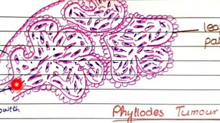 Fibroadenoma And Phyllodes Tumor  Pathology [upl. by Doss]