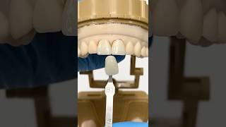 Central Zirconia Incisors ​⁠EnvisiontecMain envisiontec lsk121shorts dentistry teeth [upl. by Janice]