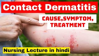 contact dermatitis  cause symptoms treatment nursing care  nursing lecture in hindi  msn [upl. by Liag]