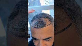 Rare hair transplant Balding behind the forelock post op vincihairclinic shorts [upl. by Anitnatsnoc733]