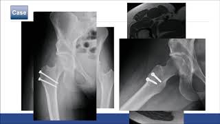 Incidence of ischiofemoral impingement in patients undergoing PAO  E Sink [upl. by Nerraf]