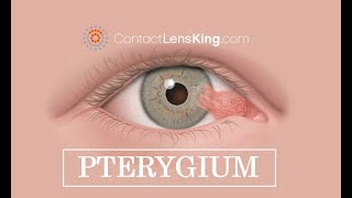 Pterygium Eye Surfers Eye Treatment Causes and Symptoms [upl. by Naig]