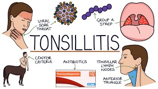 Understanding Tonsillitis [upl. by Fotinas]