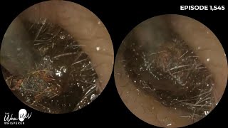 1545  Patient Still Felt Ear Was Blocked After Ear Wax Removal [upl. by Naaitsirhc]