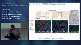 Glycosylation in cancer [upl. by Tilford]