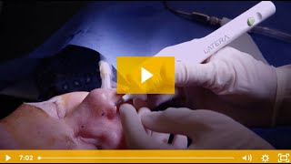 LATERA implant technique video [upl. by Elle]