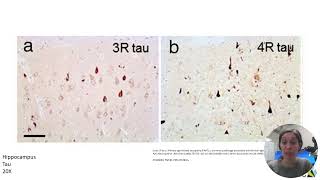 Neuropathology  Part 2 [upl. by Sankey]