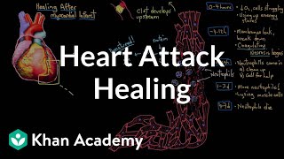 Healing after a heart attack myocardial infarction  NCLEXRN  Khan Academy [upl. by Enneiviv]