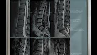 Lumbar Pathology from wwweducaredesign [upl. by Howell]