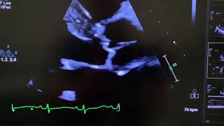 Infective endocarditis of aortic valve with fail RCC and perforation of RCC [upl. by Winser]