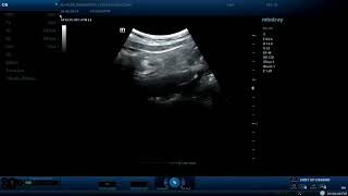 Appendicitis  ultrasound cases [upl. by Hayott340]