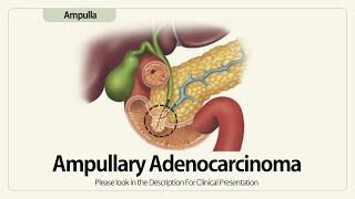 Ampullary Adenocarcinoma [upl. by Cazzie]