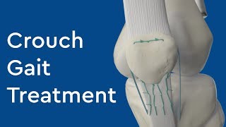 What is Crouch Gait Treatment [upl. by Fabrin]