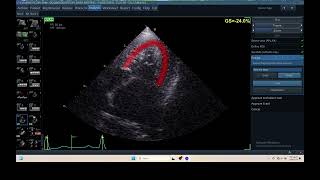 IQ 306 AFI LV ECHOPAC ANALYSIS HEPATOMA PTE ECHOCARDIOGRAPHY [upl. by Eidod730]