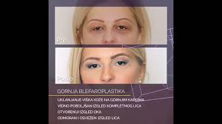 Blefaroplastika gornjih kapaka Upper eyelid blepharoplasty operacija kapaka Medica Aesthetica [upl. by Ecyt694]