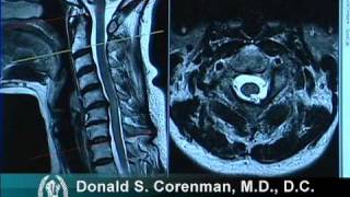 How to Read a MRI of Cervical Stenosis with Spinal Cord Injury  Spine Surgeon in Colorado [upl. by Euqinamod]