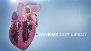 Watchman™ Left Atrial Appendage Occlusion [upl. by Colt327]