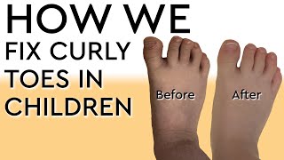 How We Fix Curly Toes in Children [upl. by Ailatan452]