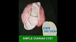 SIMPLE OVARIAN CYST [upl. by As]