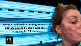 Woman Addicted to Tanning Unveils Sunbed Damage After 15 Years of Daily Use [upl. by Halbeib443]