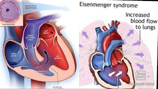 Eisenmenger syndrome fmge next neetpg [upl. by Ebarta684]