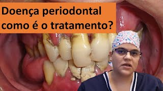 Doença periodontal tem cura qual o tratamento Dra Bianca Rosa  Clínica Bianca Rosa [upl. by Beauvais]