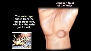 Ganglion Cyst Wrist  Everything You Need To Know  Dr Nabil Ebraheim [upl. by Kipp]