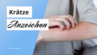 Krätze Das sind typische Anzeichen [upl. by Hazeghi]