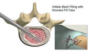 Spineology OptiLIF with the OptiMesh Expandable Interbody Fusion System [upl. by Enelyw307]