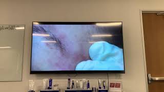 Dr Obagi demonstrating extractions and kenalog injections into acne cysts [upl. by Yttam]