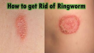 Ringworm Treatment At Home  7 Steps on How to Cure Ringworm Fast [upl. by Aiuqal858]