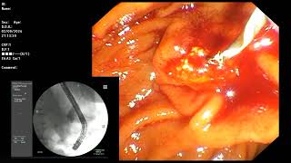 ERCP  Distal CBD stricture for FCSEMS [upl. by Ahsiened581]