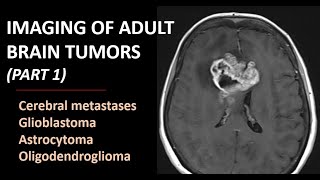 Imaging of brain tumors part 1 metastases glioblastoma and beyond [upl. by Aviv13]