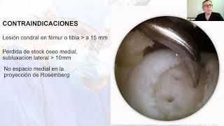 Webinar Osteotomía tibial alta [upl. by Airdnahs177]