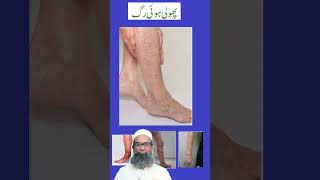 Varicose Veins  Part 1  Causes Symptoms and Homeopathic treatment  Shahbaz Qamar [upl. by Burk]