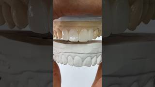 Fixing Chipped Incisors envisiontec envisiontec lsk121shorts teeth dental [upl. by Noble]