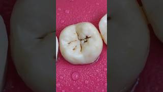 Doing Tooth Restoration  Repairing Pit and Fissure Caries toothwear toothed shorts short [upl. by Dilahk344]