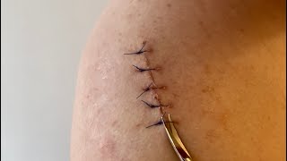 Removal of suturesstitches at Home Following surgical biopsy excision Educational video [upl. by Sihun]