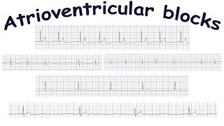 Atrioventricular blocks [upl. by Weiler298]