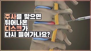 주사를 맞으면 튀어나온 디스크가 다시 들어가나요 [upl. by Harragan51]