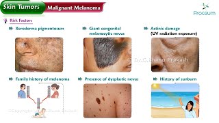 Malignant Melanoma Risk factors Types Characteristic features Diagnosis Surgery [upl. by Neeka548]