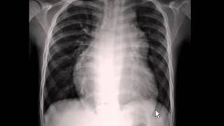 Chest xray  pulmonary arterial hypertension [upl. by Hope]