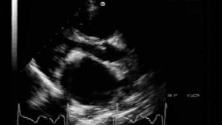 MS different aspectscalcified mitral stenosis [upl. by Halli]