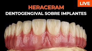 DENTOGENGIVAL SOBRE IMPLANTES  METALOCERÂMICAS  HERACERAM [upl. by Sebastiano724]