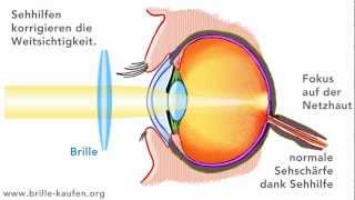 Was ist Weitsichtigkeit Hyperopie [upl. by Sass]