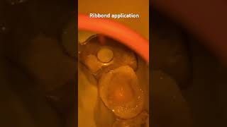 Ribbond application طريقة تطبيق شريط الريبوند … دكتور حيدر رزاق dr hayder razzaq [upl. by Oicam]