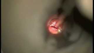 Left Middle Ear Ventilation Grommet Tube insertion  Dr Nirmal Patel Sydney Australia [upl. by Arhna]