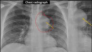 Case Discussion  Anterior Mediastinal mass [upl. by Battat58]